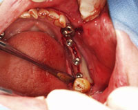 吉本歯科医院での症例 写真1