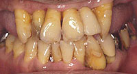 歯周病炎症写真：ここまでくると痛み、出血など悪い症状が出てきます