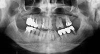 入れ歯になる前に治しましょう「歯周病レントゲン写真」
